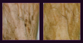 Laser Skin Spot Removal