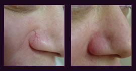 Laser Thread Vein Removal